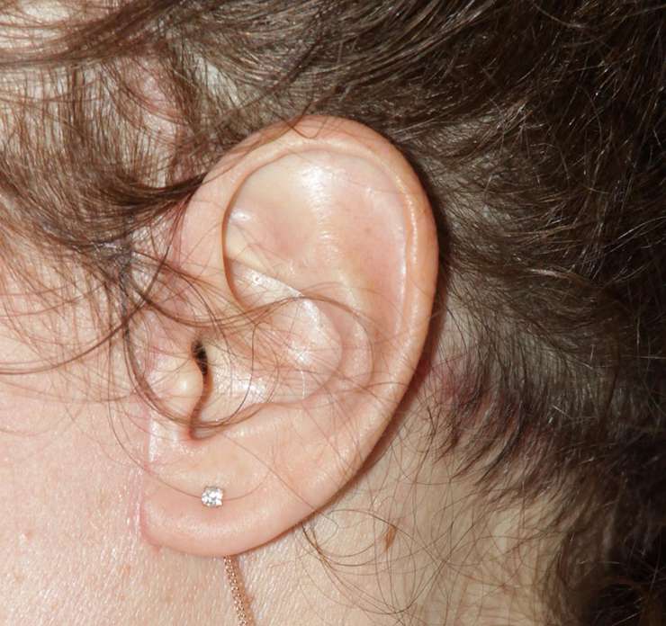 На фото можно увидеть, как выглядит шов через 3 недели после SMAS подтяжки лица. На фото можно увидеть, как выглядит шов через 3 недели после SMAS подтяжки лица.