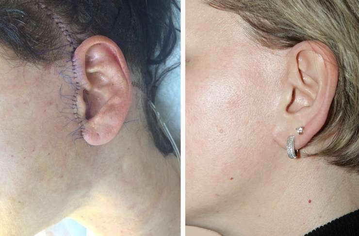 На фото: шов после SMAS подтяжки, в день операции и через 8 недель после нее. На фото: шов после SMAS подтяжки, в день операции и через 8 недель после нее.