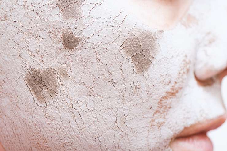 В сухом остатке: как справиться с шелушением В сухом остатке: как справиться с шелушением