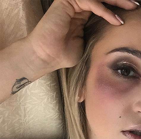 Ольга Бузова с синяком под глазом. Фото: Instagram.com/buzova86. Ольга Бузова с синяком под глазом. Фото: Instagram.com/buzova86.