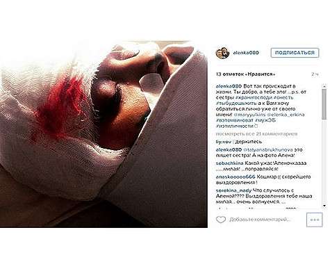 Вот такое фото опубликовала Алена Волкова, а в комментариях обвинила в избиении «мужа ЭБ». Фото: Instagram.com/alenka080.