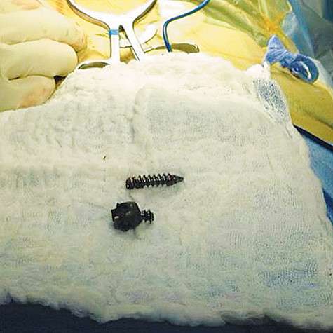 Сломанный шуруп, который Евгению Плющенко удалили во время операции. Фото: Instagram.com.