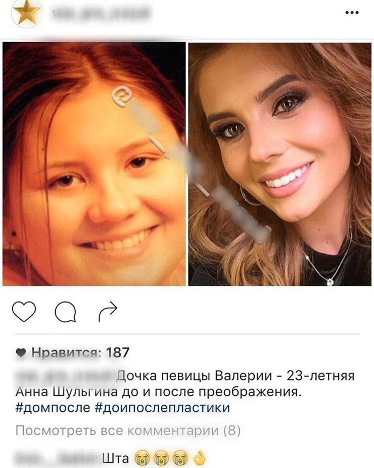 Анна Шульгина опровергла вмешательства пластических хирургов в ее внешность