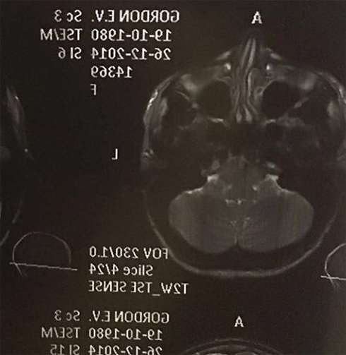 Катя Гордон сделала ринопластику