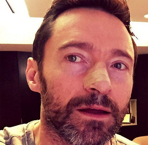 У Хью Джекмана снова рак