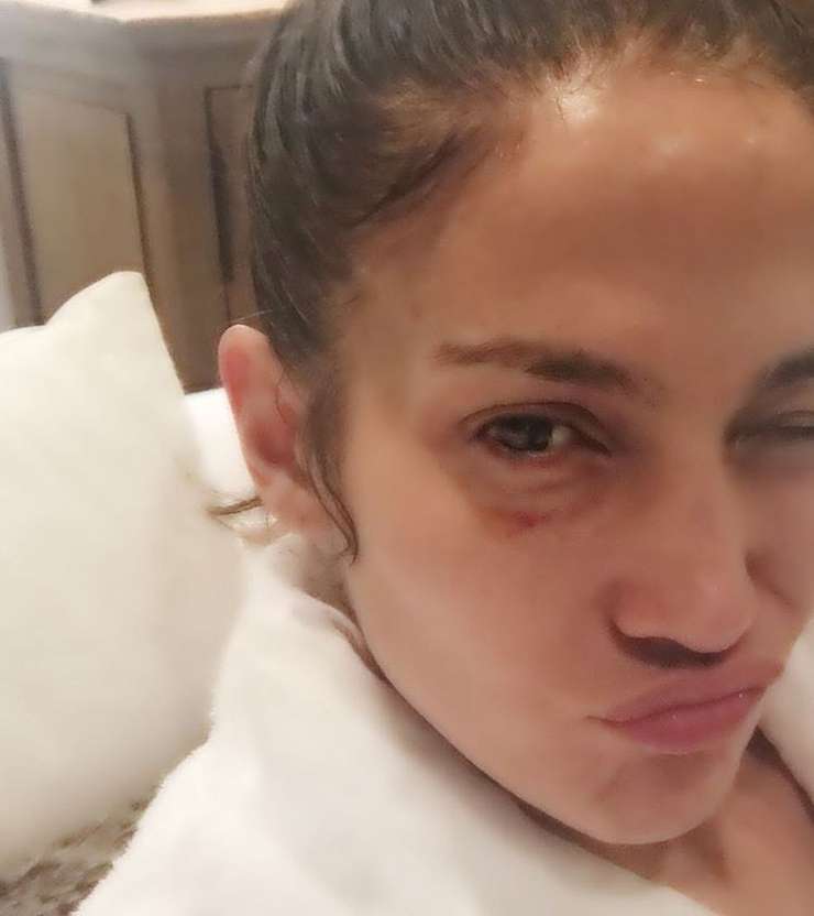 Джей Ло показала лицо с фингалом под глазом