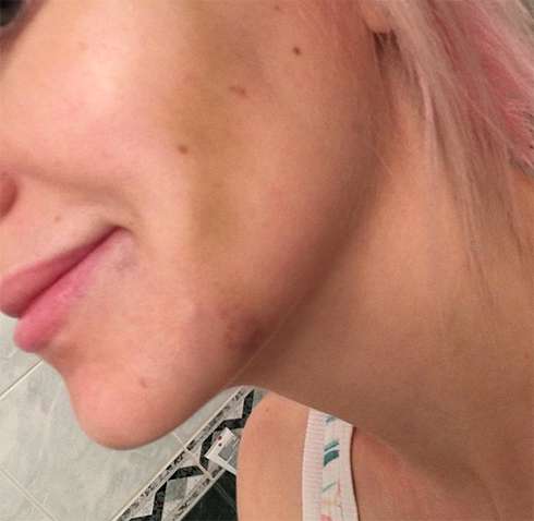 natali_star74: «Синяк от ниточки-то во всю щеку...»