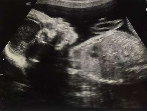 Актриса поделилась УЗИ-снимком будущего ребенка