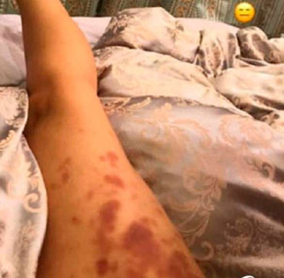 Романец показала синяки перед свадьбой