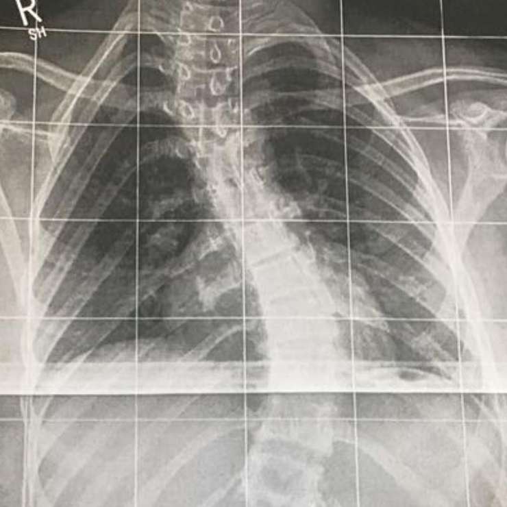 В позвоночник Сони вставили 20 шурупов В позвоночник Сони вставили 20 шурупов