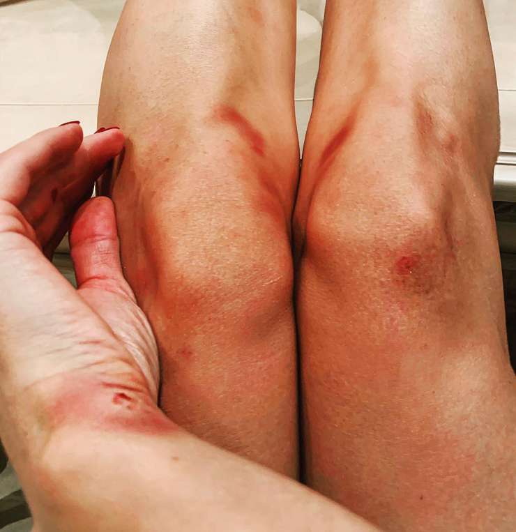 Травмы Светлана Лобода получила во время выступления