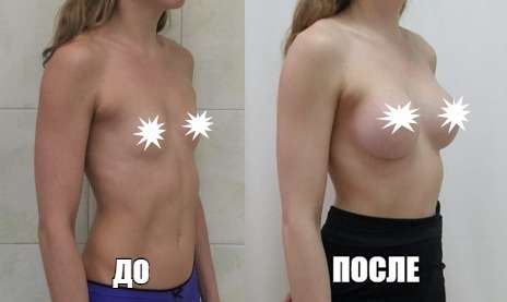 Пациентка до и после пластики груди