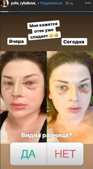 Юлия Рыбакова переделала нос