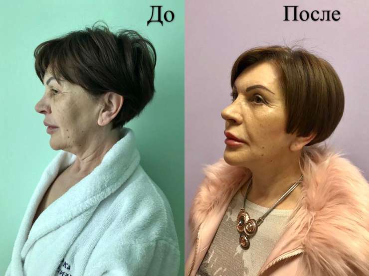 Как омолодить шею: самые эффективные операции - Красота - WomanHit.ru