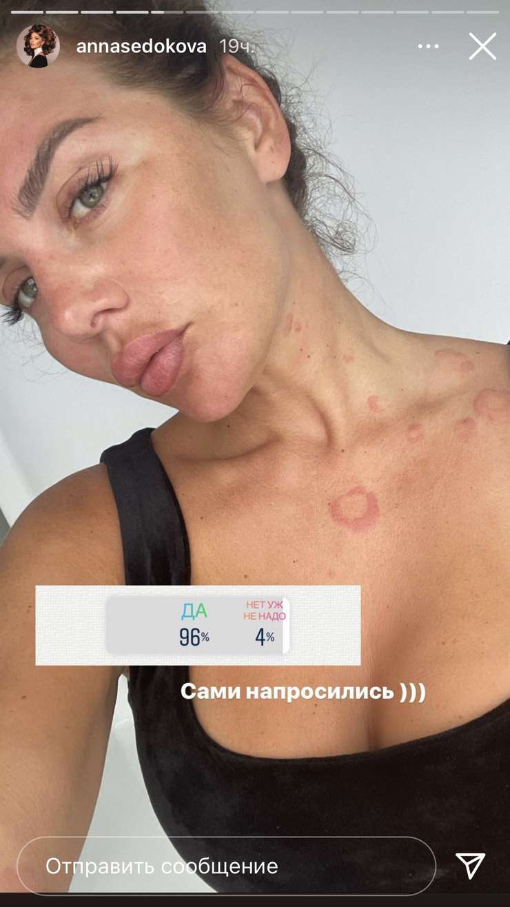 Артистка сильно отекла и покрылась красными пятнами