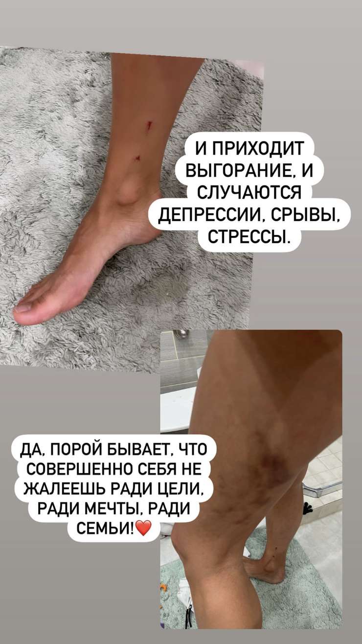 Ведущая показала свои увечья на ногах