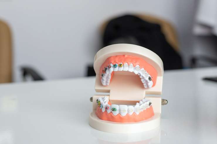 современная стоматология может предложить разные виды брекетов