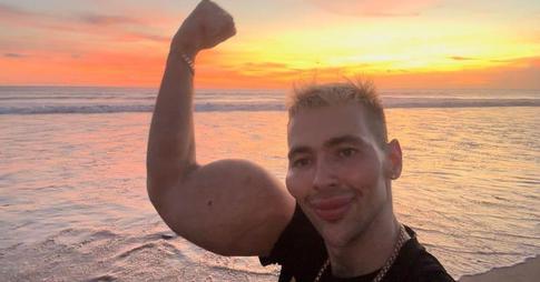 «Руки-базуки» ужаснул подписчиков новой пластической операцией