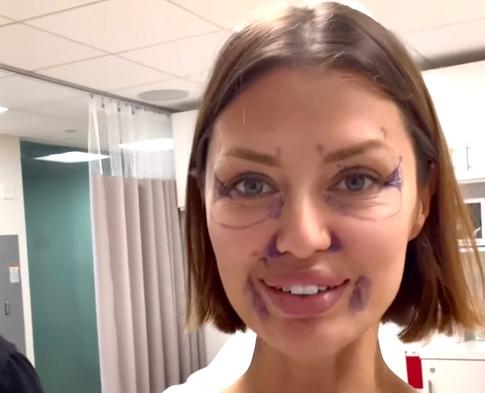 Боня опубликовала свое первое фото после пластики лица