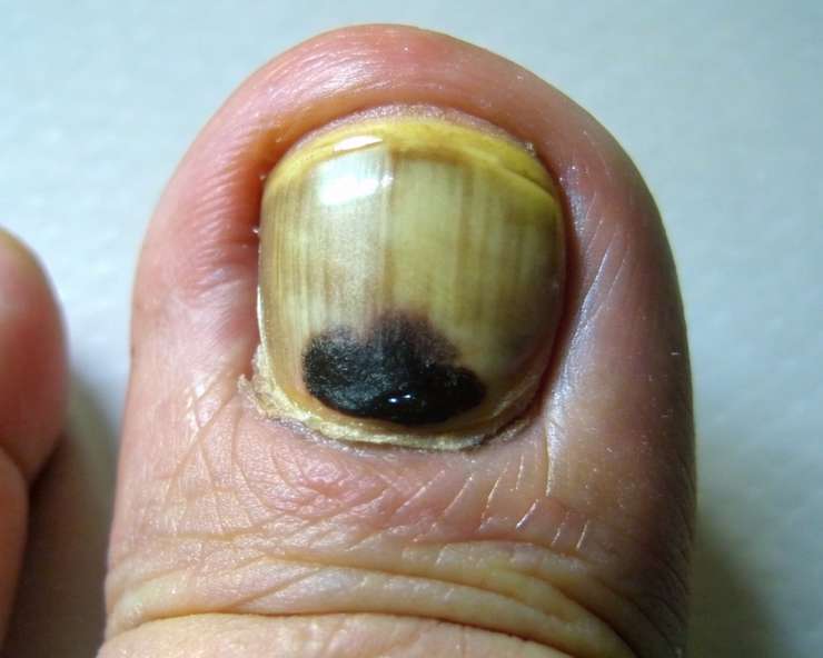 какие виды грибка существуют