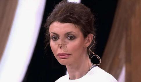 Алиса Аршавина прошла через 9 операций на нос после его почти полной потери