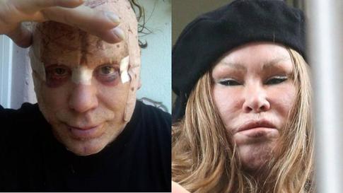 Цена красоты: пластический хирург назвал звезд, лишившихся привлекательности из-за пластики