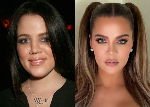 Новая искренность: как Хлои Кардашьян и другие звезды открыто говорят о пластике