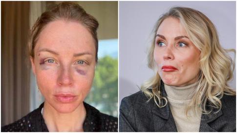 «Можно ли так упасть?»: Гордон намекнула на происхождение синяков на лице Дибровой