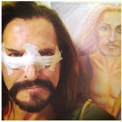 Джигурда сделал операцию по подтяжке век