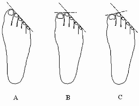 При сильной половой конституции большой палец ноги короче указательного, как на рисунке C.