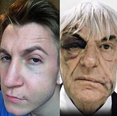 Сегодня Дмитрий Шаракоис сделал коллаж, сравнив свое избиение с побоями владельца «Формулы 1» Берни Экклстоуна, когда того ограбили в 2010 году. Фото: Instagram.com/sharakois. Сегодня Дмитрий Шаракоис сделал коллаж, сравнив свое избиение с побоями владельца «Формулы 1» Берни Экклстоуна, когда того ограбили в 2010 году. Фото: Instagram.com/sharakois.