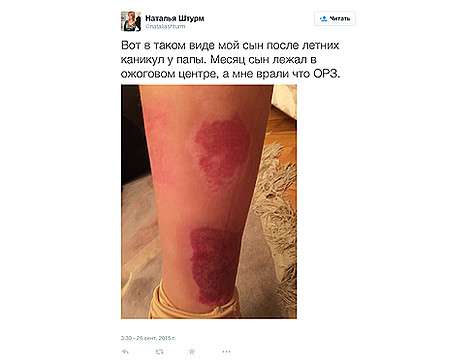 Вот с такими ожогами ребенок Натальи Штурм вернулся после каникул, проведенных у папы. Фото: Twitter.com/@nataliashturm.