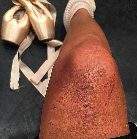 Во время отдыха в Турции Волочкову укусило неизвестное животное. Фото: Instagram.com/volochkova_art.