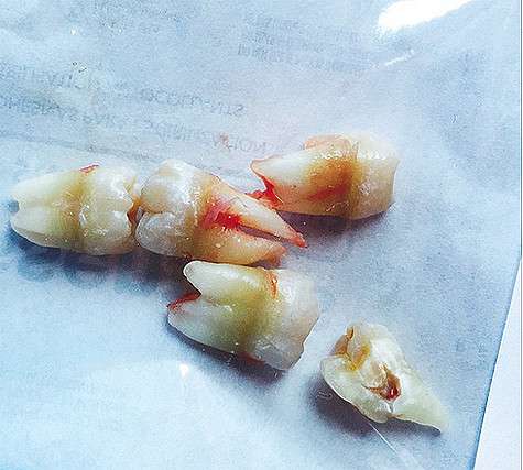 Вырванные зубы Майли Сайрус. Фото: Instagram.com/mileycyrus.