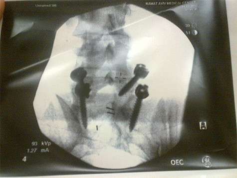 Рентген Евгения Плющенко. Фото: Twitter.com.