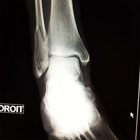 Рентгеновский снимок ноги Ренаты Литвиновой. Фото: Twitter.com.