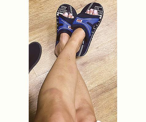Кудрявцева поделилась с поклонниками снимками своих ног в синяках. Фото: Instagram.com/Leratv.
