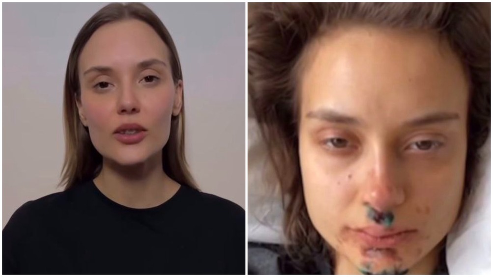 Кологривый, Бортич и другие поддержали пострадавшую в ДТП с самокатом коллегу