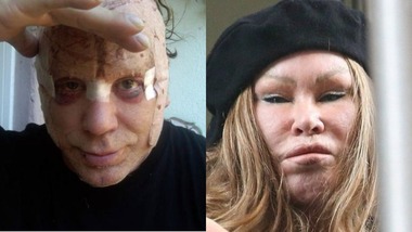 Цена красоты: пластический хирург назвал звезд, лишившихся привлекательности из-за пластики