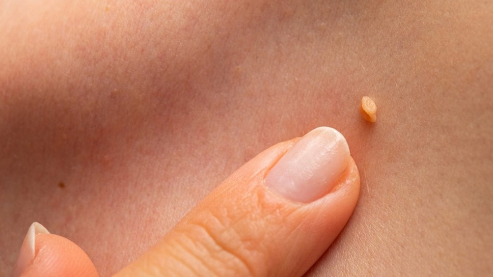 Папилломы: 7 способов быстро убрать их дома