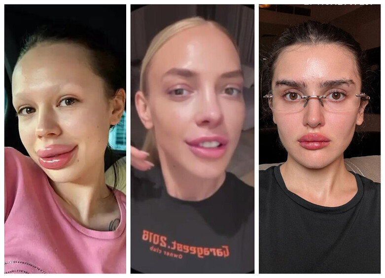 Сысоева, Инстасамка, Саева и другие звезды, удалившие филлеры: в шоке от результата