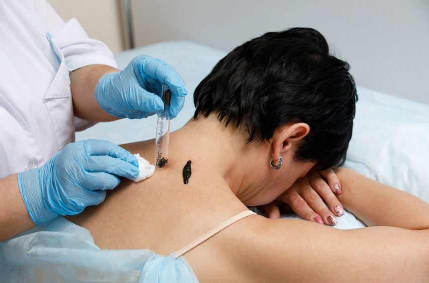 Гирудотерапия: зачем добровольно сажать на себя пиявок по весне