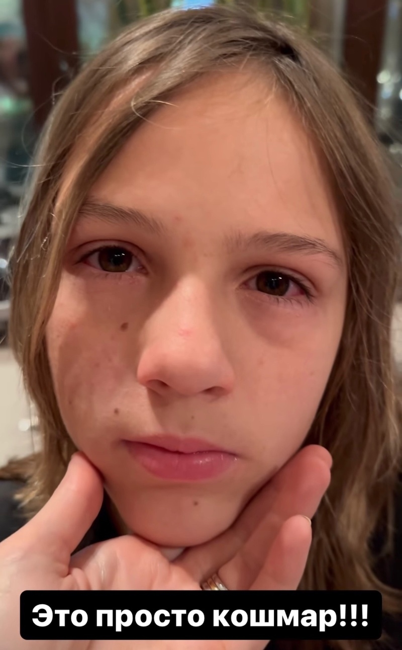 Жена Дмитрия показала воспаления на лице сына Александра