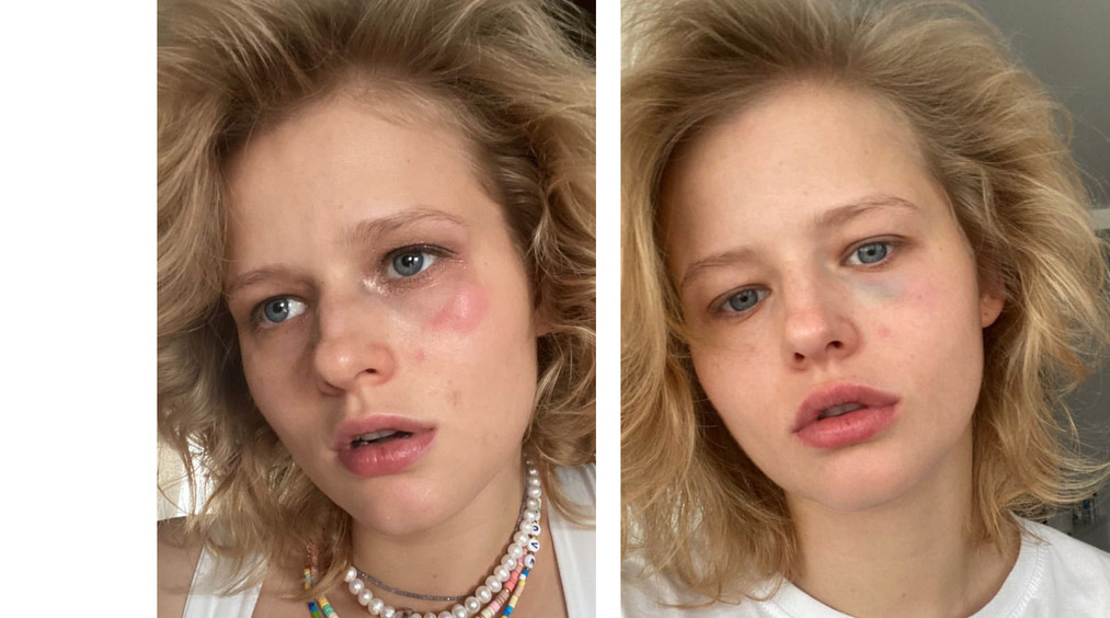 В день 28-летия Александра Бортич получила сильный удар в глаз