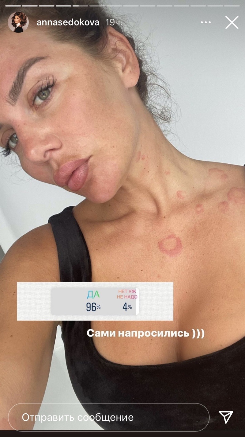 Артистка сильно отекла и покрылась красными пятнами