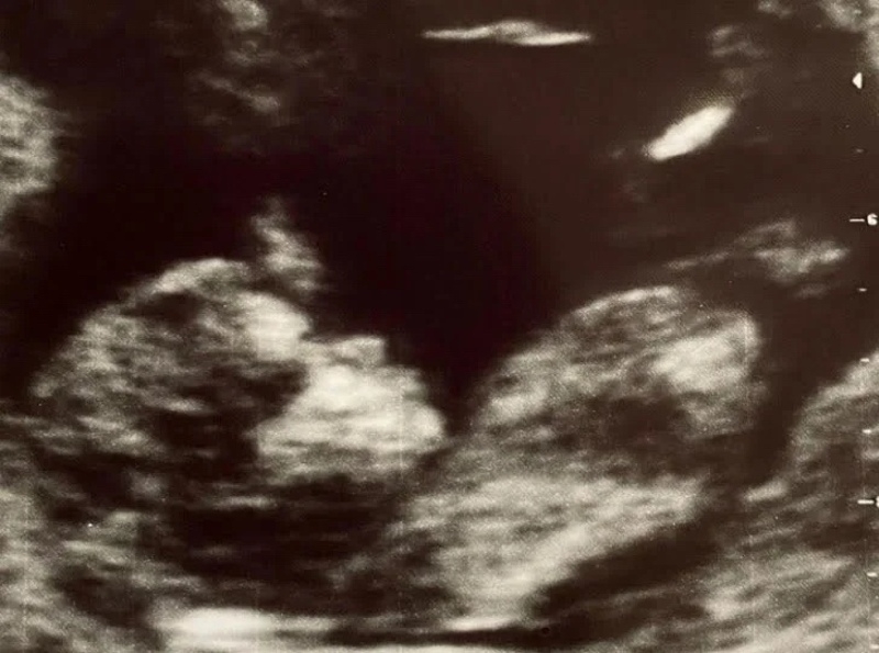 УЗИ будущего внука певицы Наргиз