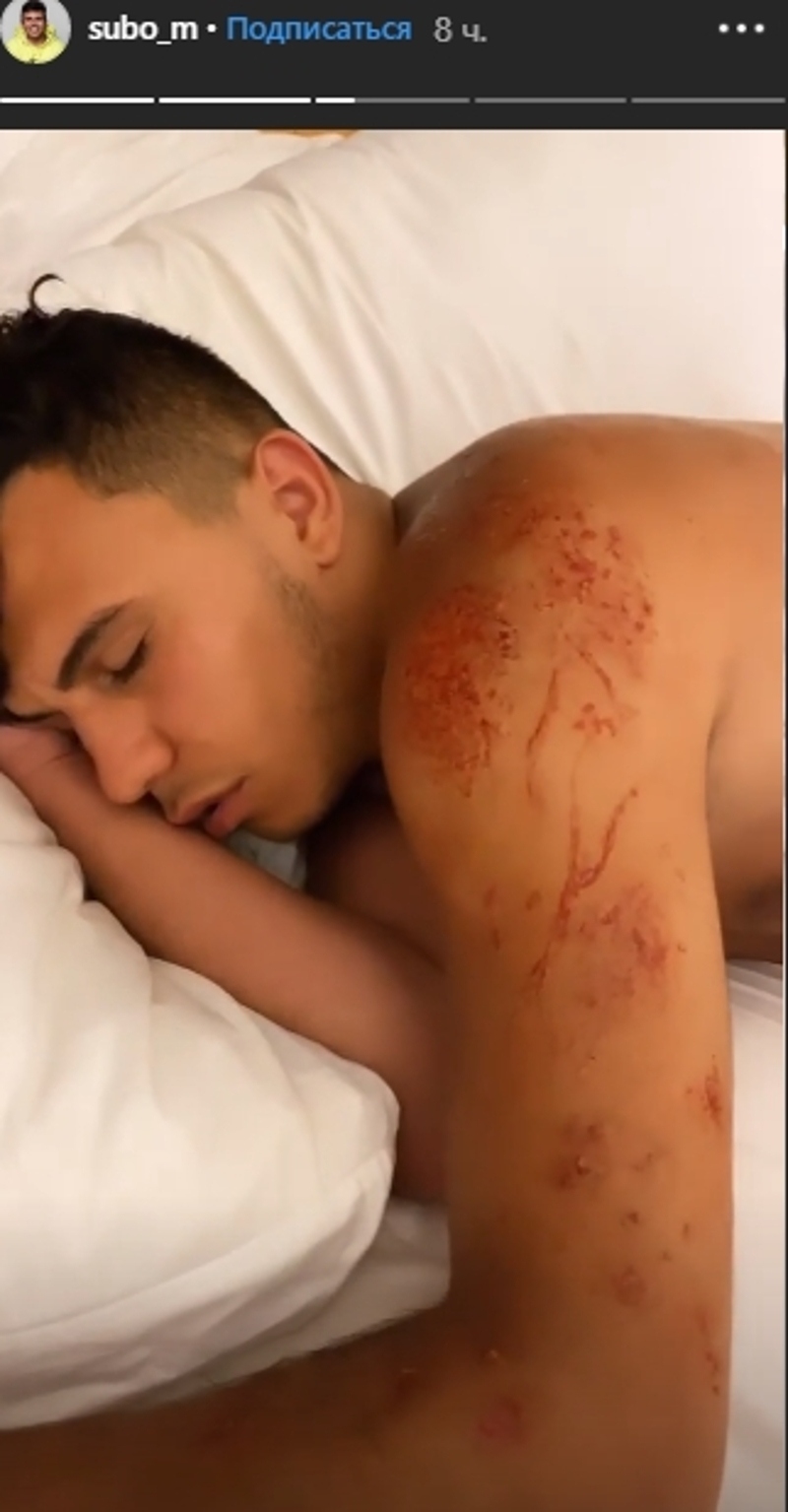 Певец и блогер Subo сильно пострадал от укуса медузы на Бали