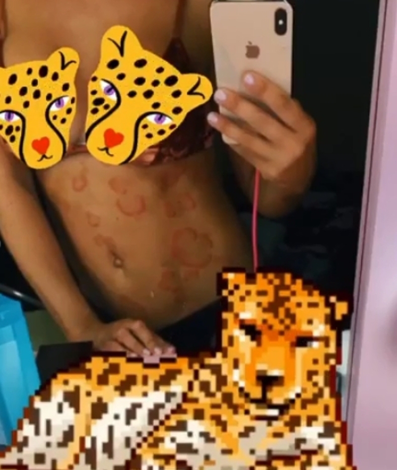 Крапивница сделала Седокову похожей на леопарда