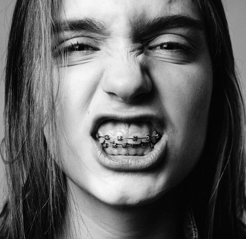 Брекет-системы бывают разные