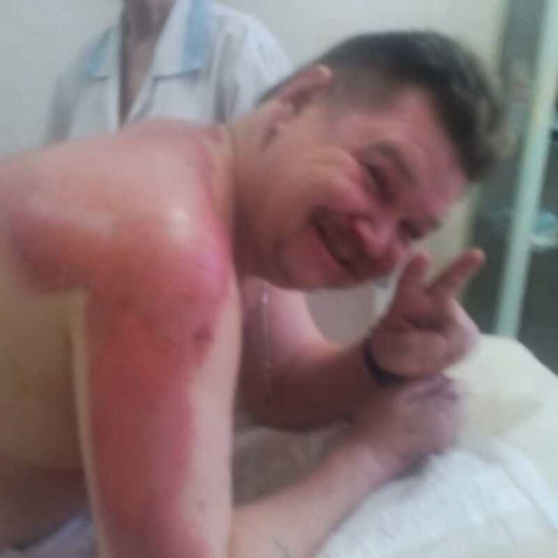 Николай Бандурин получил серьезные ожоги во время пожара